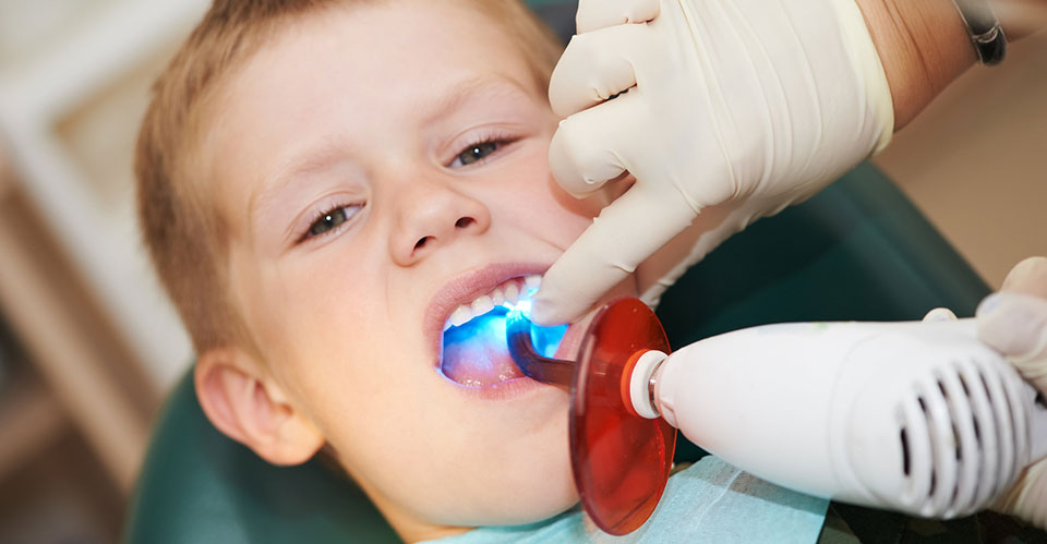 Dental Sealants for Cavity Prevention