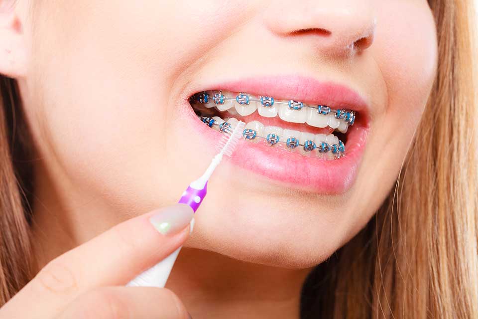 Brushing and flossing with braces 
