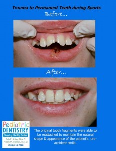 Teeth Trauma- From Sporting Accident