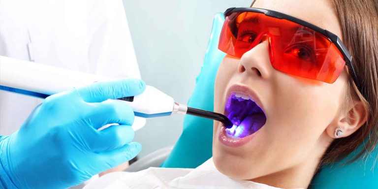 What are dental sealants?